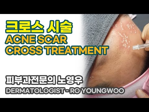 ■ 크로스 시술 (acne scar cross treatment) 청담오라클피부과